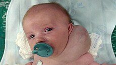 Malý Adámek s cévní vadou na krku.