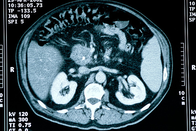 Diabetes and Family History: New Screenings Help Combat Pancreatic Cancer