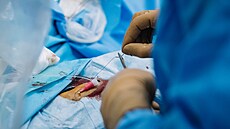 Operaní zákrok léby aortální stenózy metodou TAVI (kategorizaní náhrada...
