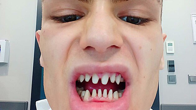 Dvaadvacetilet� model Jack James cht�l m�t dokonal� chrup, proto se rozhodl pro z�krok v Turecku, kde objevil levnou kliniku. M�sto dokonal�ho �sm�vu mu v�ak zbyly o�i pro pl��. Pot�kal se s infekc� a o vlastn� zuby nakonec m�lem p�i�el.