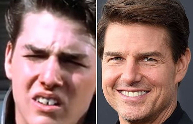 OBRAZEM: Slavní, kteří vsadili na zubní implantáty