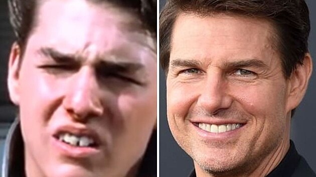 Herec Tom Cruise s k�iv�mi zuby rozhodn� nebyl mil��kem Hollywoodu. S rovn�mi zuby vypad� dnes mnohem l�pe.