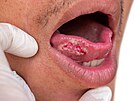 Spinocelulární karcinom jazyka.