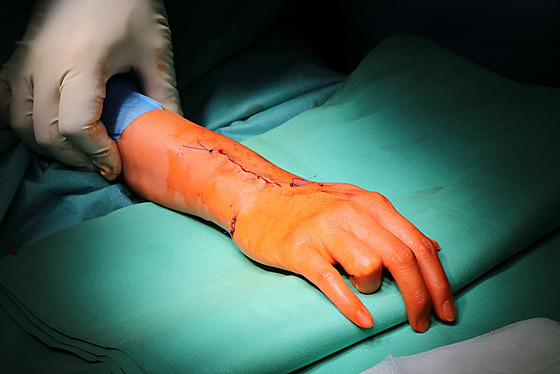 Ruka pacientky po voperování implantátu.