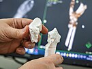 Modely kostí z 3D tiskárny pomáhají lékam ve Fakultní nemocnici Ostrava s...