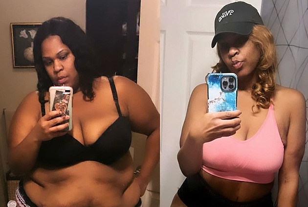 Žena chtěla shodit kila navíc, podařilo se to až po třetí operaci žaludku