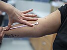 M��en� rukou pacientek po z�kroku vedouc�mu k odstran�n� lymfatick�ch otok�...