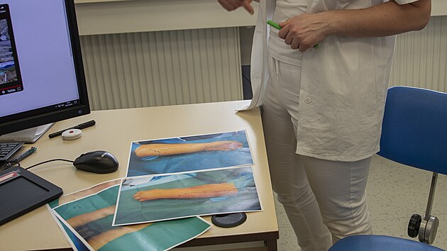 Lkaka Katarna Polchov s fotografiemi rukou pacientek ped zkrokem vedoucm k odstrann lymfatickch otok rukou po lb rakoviny prsu. Ve FN Brno k nmu jako prvn v Evrop pouili exoskopii.