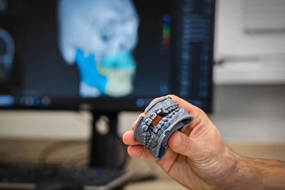 Model chrupu z 3D tiskárny pomáhá v ostravské fakultní nemocnici eit závané...