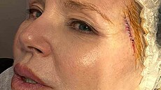Christie Brinkleyová po operaci rakoviny ke (14. bezna 2024)