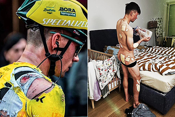 Slovinský cyklista Primo Rogli ukázal fotografie svého rozedeného tla