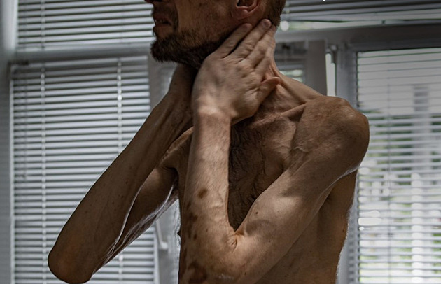 Sláva Rusku vypálená do břicha. Zajatce zohavili chirurgové, zjistili investigativci