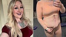 Kvli plastice bicha mla ena velké zdravotní komplikace.