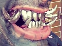 Jednou z nejvýraznjích modifikací jsou chromové zubní implantáty.