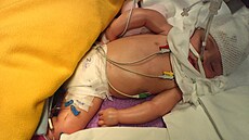 Karolínka po útoku matky