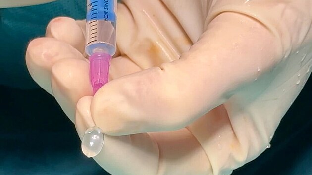 L�ka�i plodu nitro�iln� zavedli do d�chac�ch cest balonek o velikosti slzy. (25. �ervence 2024)