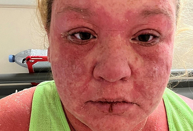 Ženu bodl na dovolené komár. V reakci s antibiotiky odpadala kůže, vlasy i nehty