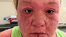 en po kousnutí tygím komárem odpadala ke, vlasy a nehty. (5. února 2023)