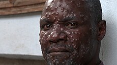 V Africe �ádí opi�í ne�tovice