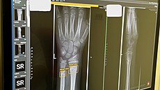 Nemocnice Pelhimov po plronm testovn spn zavedla vyuvn uml...