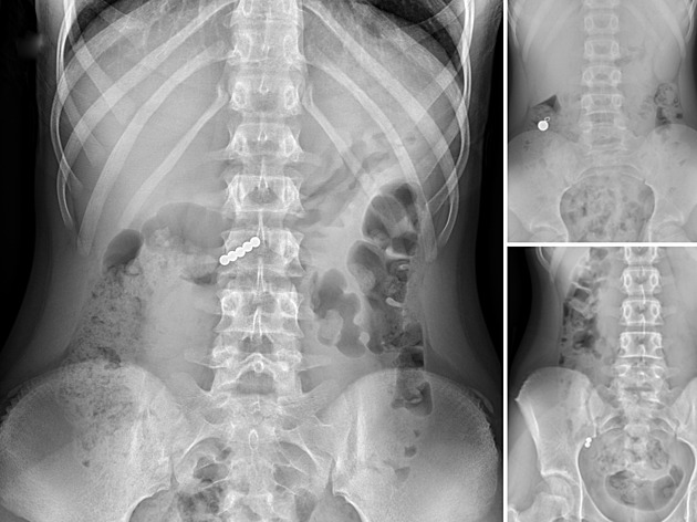 Výzva z TikToku nefunguje, varují lékaři z Motola. Děti kvůli ní spolkly magnety