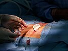 Pohled na nov� neurostimul�tor, kter� olomou�t� l�ka�i voperovali pacientovi...