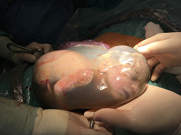 Pedasn narozené dti se porodníci ve Zlín snaí porodit ve vaku blan....