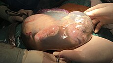 P�ed�asn� narozené d�ti se porodníci ve Zlín� sna�í porodit ve vaku blan....