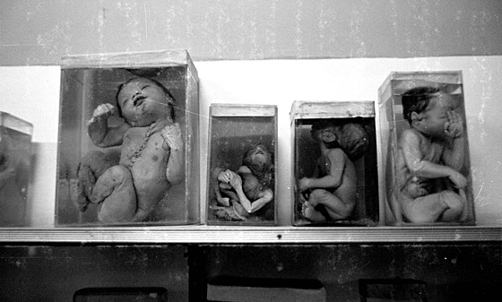 V Bhópálu se dodnes rodí d�ti s t�kými deformacemi. Nadm�rný je i výskyt...