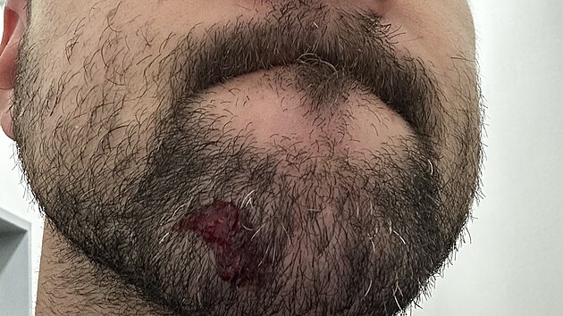 Petlakovan nboj pi vstelu nenvratn pokodil pistoli znaky Heckler a Koch. Jejho majitele Ondeje Florku lomky zbran zranily na tvi.