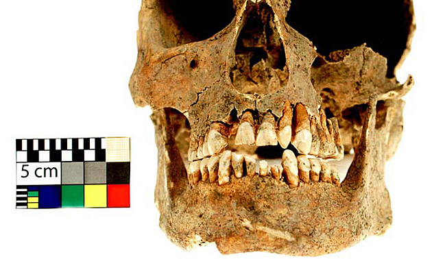 Zkoumaná lebka vojáka z p�elomu 18 a 19. století s netypickým po�kozením chrupu...