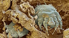 Svrab je infek�ní onemocn�ní zp�sobené parazitem záko�kou svrabovou.