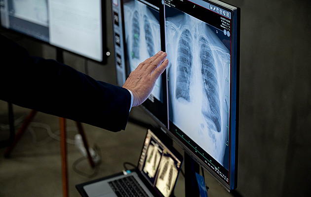 V moravskoslezských krajských nemocnicích pomáhá s odhalováním zápal� plic nebo...