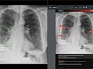 V moravskoslezsk�ch krajsk�ch nemocnic�ch pom�h� s odhalov�n�m z�pal� plic nebo...