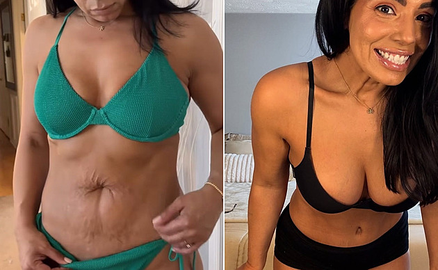 Cvičení nestačilo, po porodu k radikální změně žena potřebovala plastiku