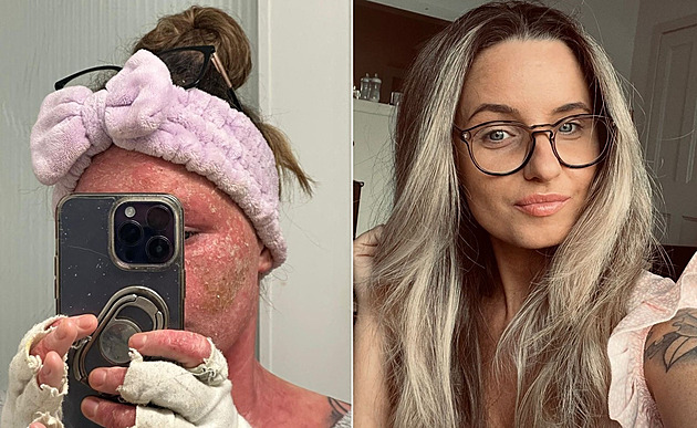 Žena po letech vysadila kortikosteroidy, tělo na ně mělo extrémní reakci