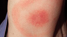 Jedním z prvních p�íznak� lymské boreliózy m��e být erythema migrans, �ervená...