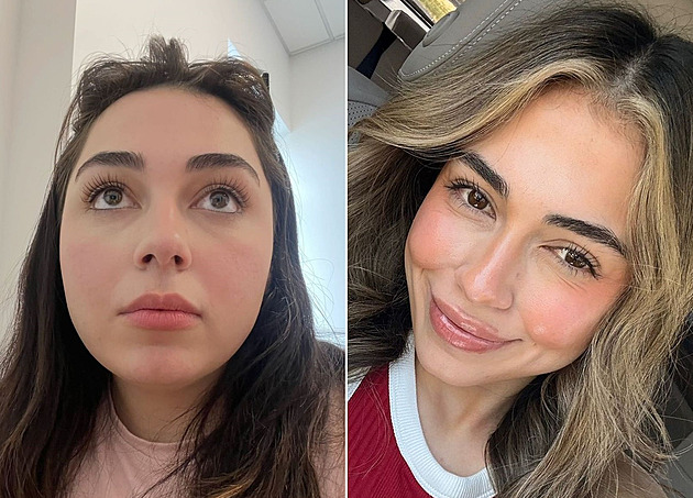 Žena po léku na hubnutí vypadá jako po plastice. Změnil se jí obličej
