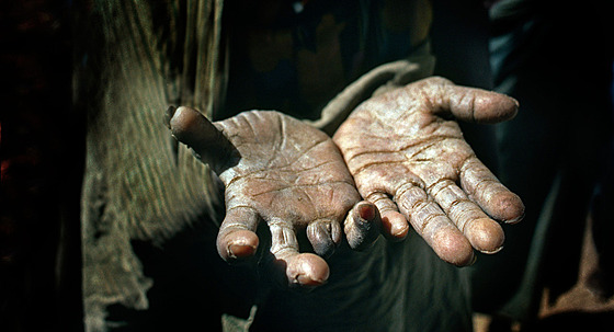 Malomocenství neboli Hansenova choroba �i lepra