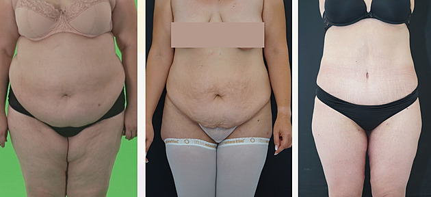 Co s kůží po zhubnutí? Takhle lékař pomohl účastníkům Extrémních proměn