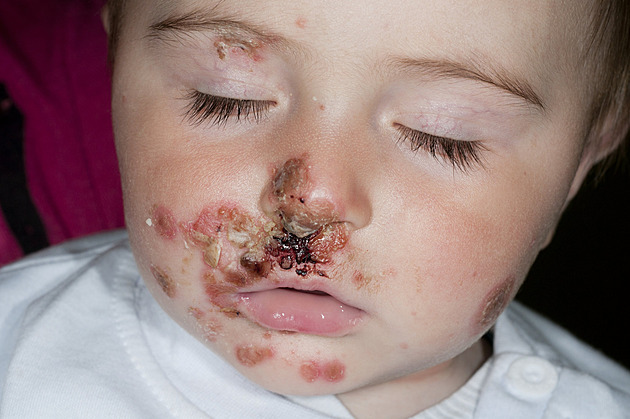 Impetigo se šíří mezi dětmi jako lavina. Jak se před touto nemocí chránit?