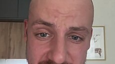 Martin Prágr byl na transplantaci vlas.