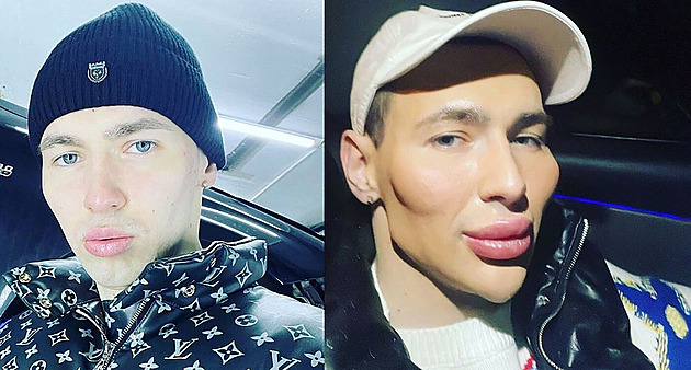 Do paží si aplikoval vazelínu, teď chce muž vypadat jako Ken