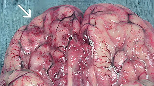 Parazit Naegleria fowleri napad mozek. (23. ledna 2023)