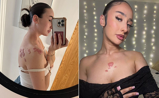 Za keloidní jizvy se styděla. Dnes je hrdě ukazuje, aby podpořila jiné ženy
