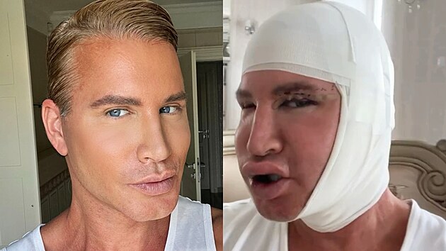 Pro bych ml tajit, e jsem si nechal udlat facelift? Pro bych se ml stydt za to, e chci vypadat lpe  pro sebe, pro sv sebevdom, pro svj pocit bt zptky ve sv ki? Robert Paulat ukzal foto po zkroku. (erven 2025)
