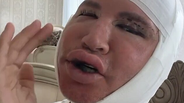 Robert Paulat ukzal na Instagramu video po nronm kosmetickm zkroku. (erven 2025)