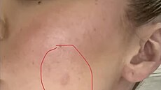 Khloé Kardashianová mla na tvái zhoubný nádor - melanom.