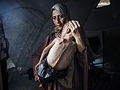 Rok a pl starý Muhammad Zakaríja Ajjúb al-Matúk trpí tkou podvýivou. (21....