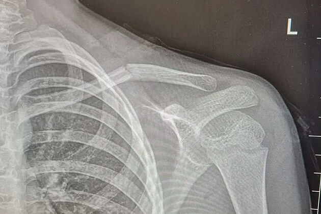 Rentgen ukazuje zlomeninu klíní kosti devítiletého chlapce.